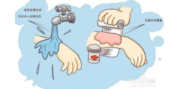 如何使用無菌注射器處理燙傷水泡